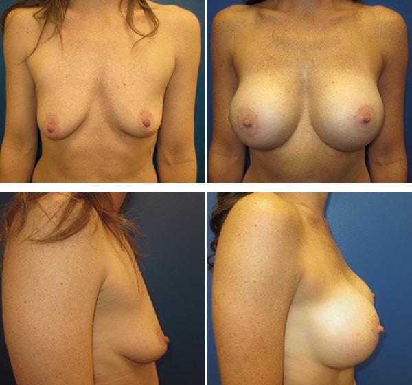 Breast Augmentation result at Plastic Surgeon Richard Fryer in Draper, UT
