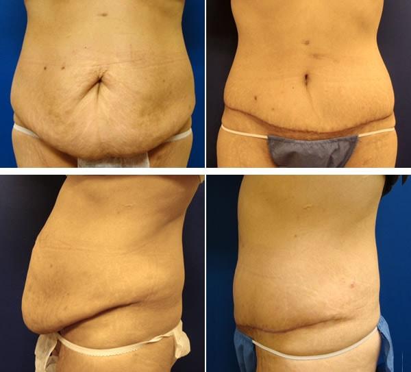 Mini Tummy Tuck result at Plastic Surgeon Richard Fryer in Draper, UT