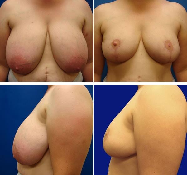 Breast Reduction result at Plastic Surgeon Richard Fryer in Draper, UT