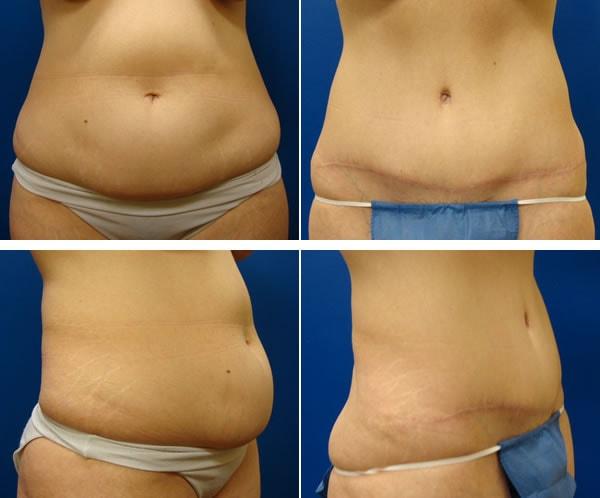 Plastic Surgeon Richard Fryer tummy tuck result — Draper, UT