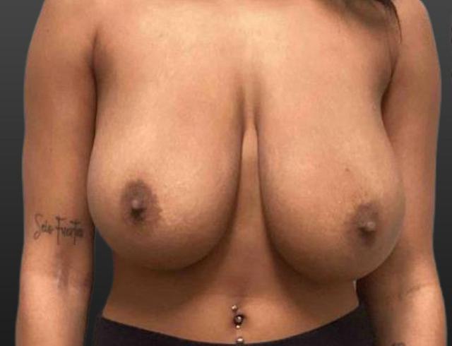 Breast Reduction before at Midwest Breast & Aesthetic Surgery in Gahanna, OH