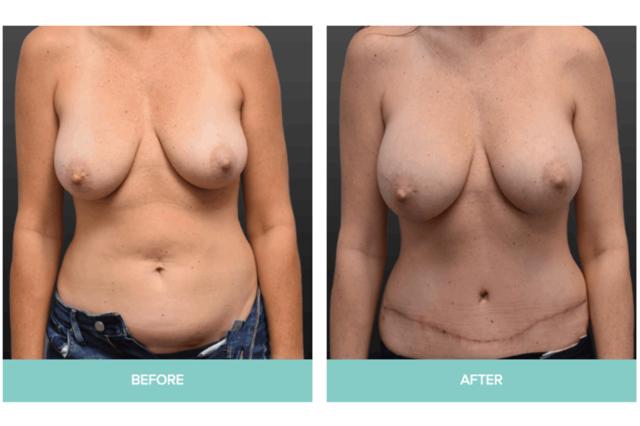 Mommy Makeover result at Midwest Breast & Aesthetic Surgery in Gahanna, OH