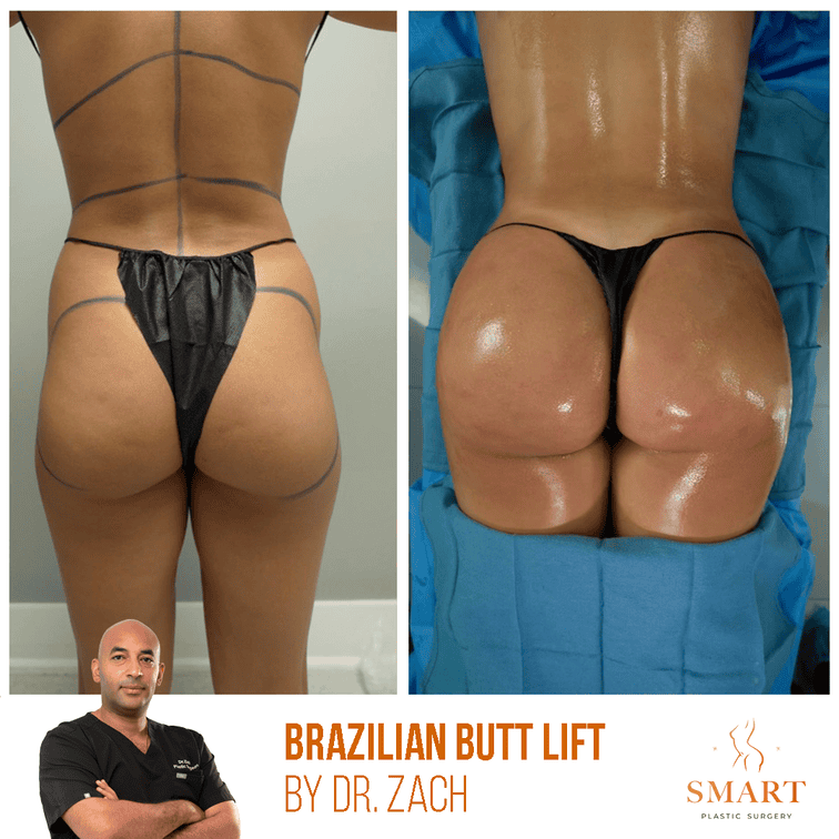 Smart Plastic Surgery bbl result — Miami, FL