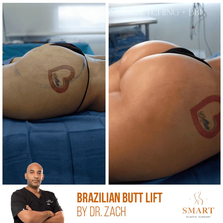 Smart Plastic Surgery bbl result — Miami, FL