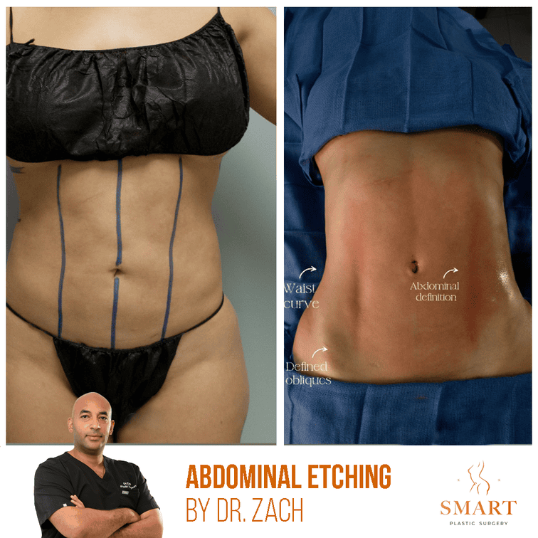 Smart Plastic Surgery body contouring result — Miami, FL