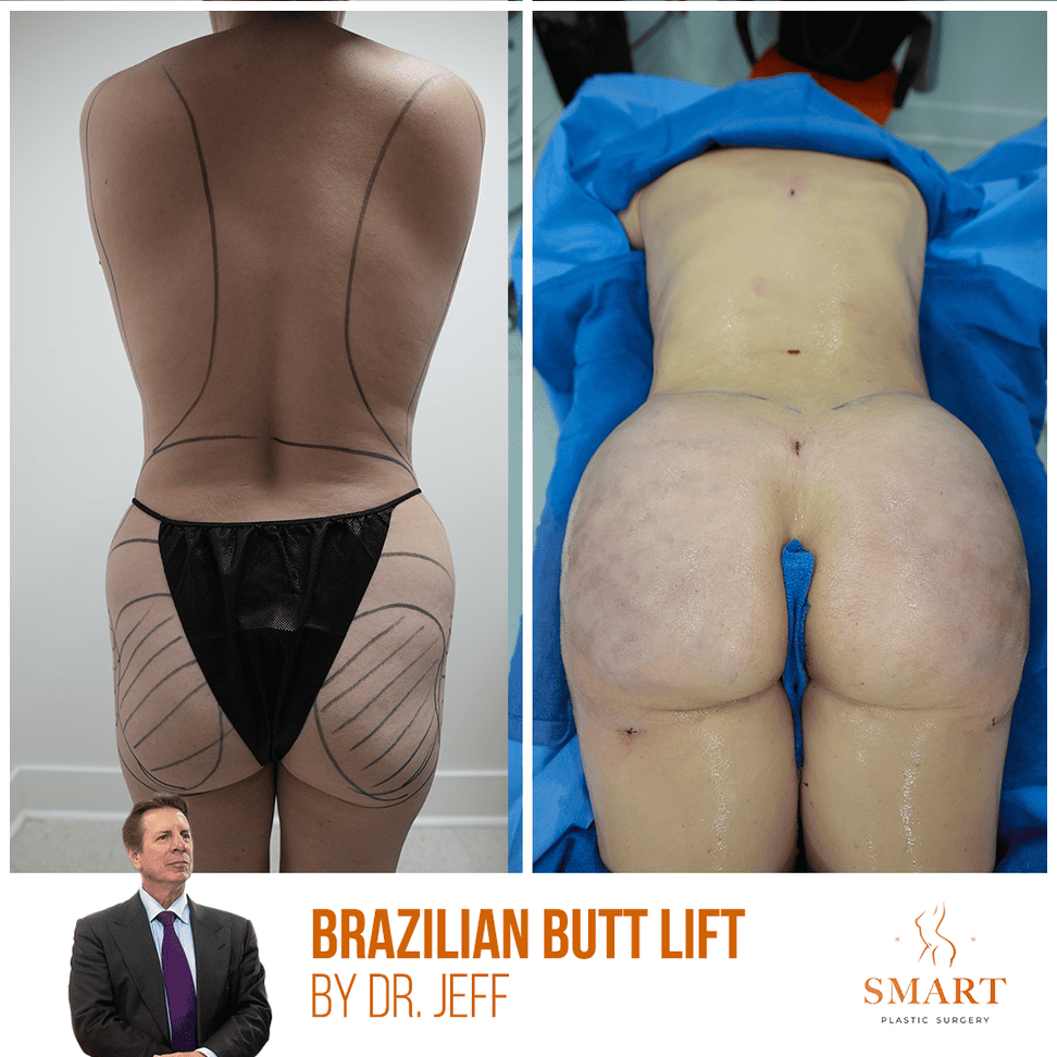 Smart Plastic Surgery body contouring result — Miami, FL