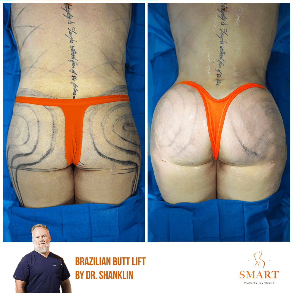 Smart Plastic Surgery body contouring result — Miami, FL