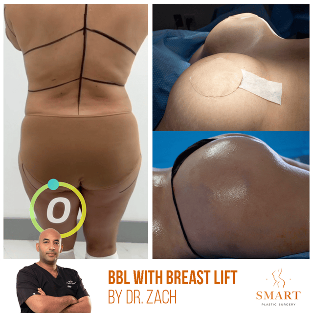 Mommy Makeover result at Smart Plastic Surgery in Miami, FL