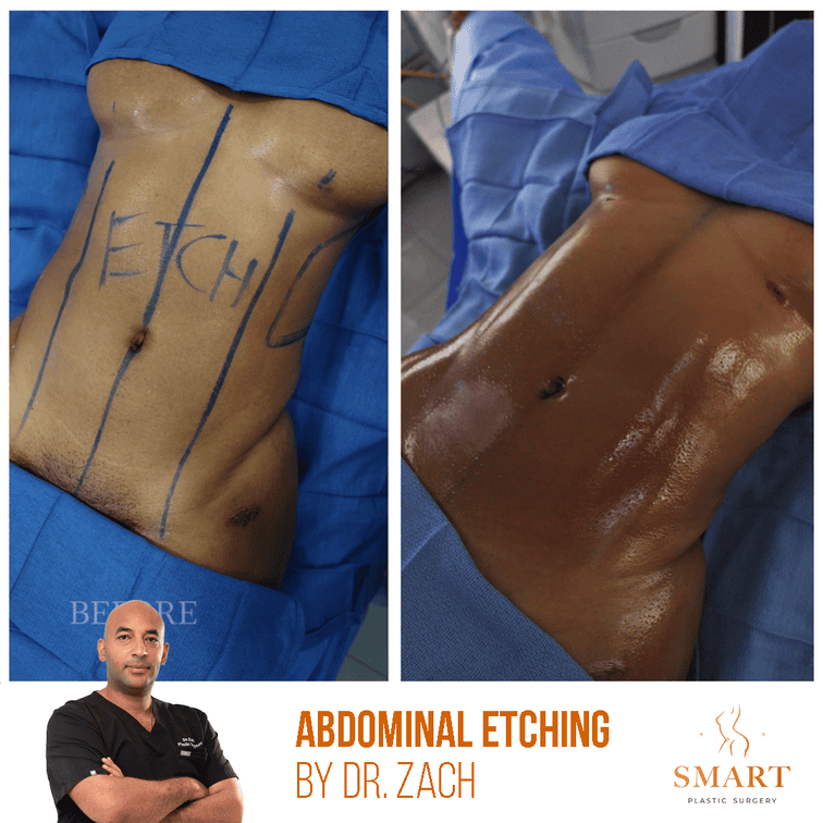 Smart Plastic Surgery body contouring result — Miami, FL