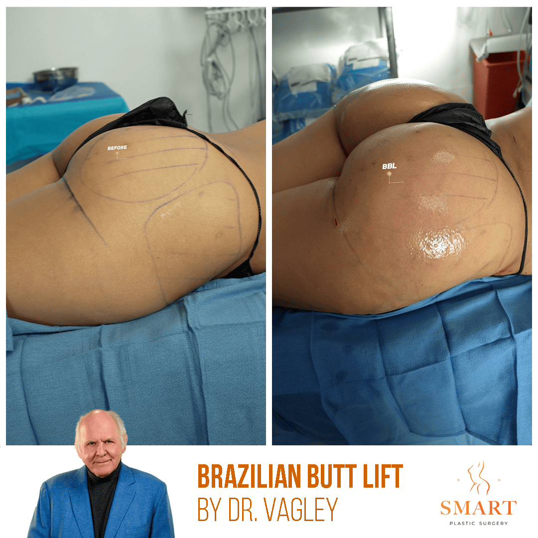 Smart Plastic Surgery bbl result — Miami, FL