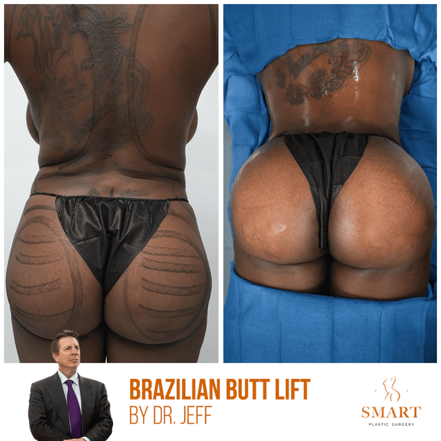 Breast Lift result at Smart Plastic Surgery in Miami, FL