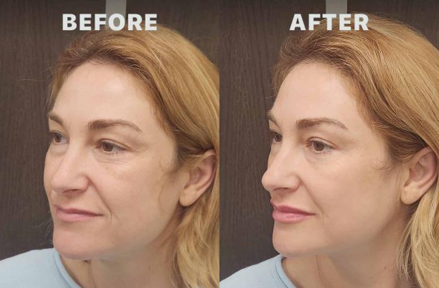 Juvederm result at Pure Health Aesthetics & Wellness in Lewis Center, OH