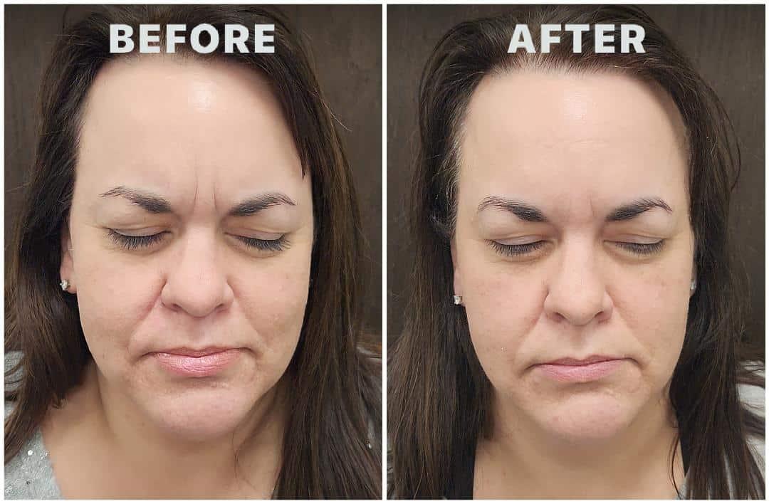 Pure Health Aesthetics & Wellness botox result — Lewis Center, OH