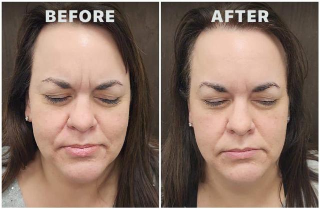 Botox result at Pure Health Aesthetics & Wellness in Lewis Center, OH