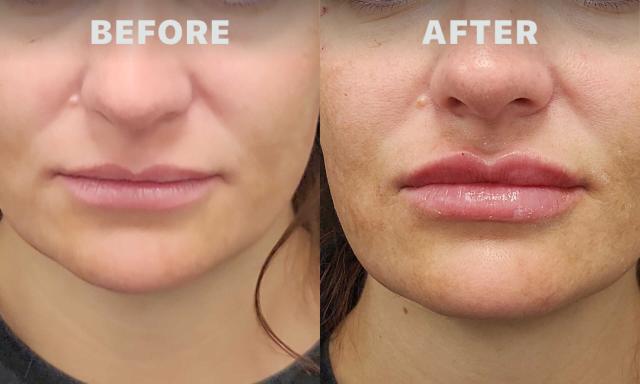Lip Filler result at Pure Health Aesthetics & Wellness in Lewis Center, OH