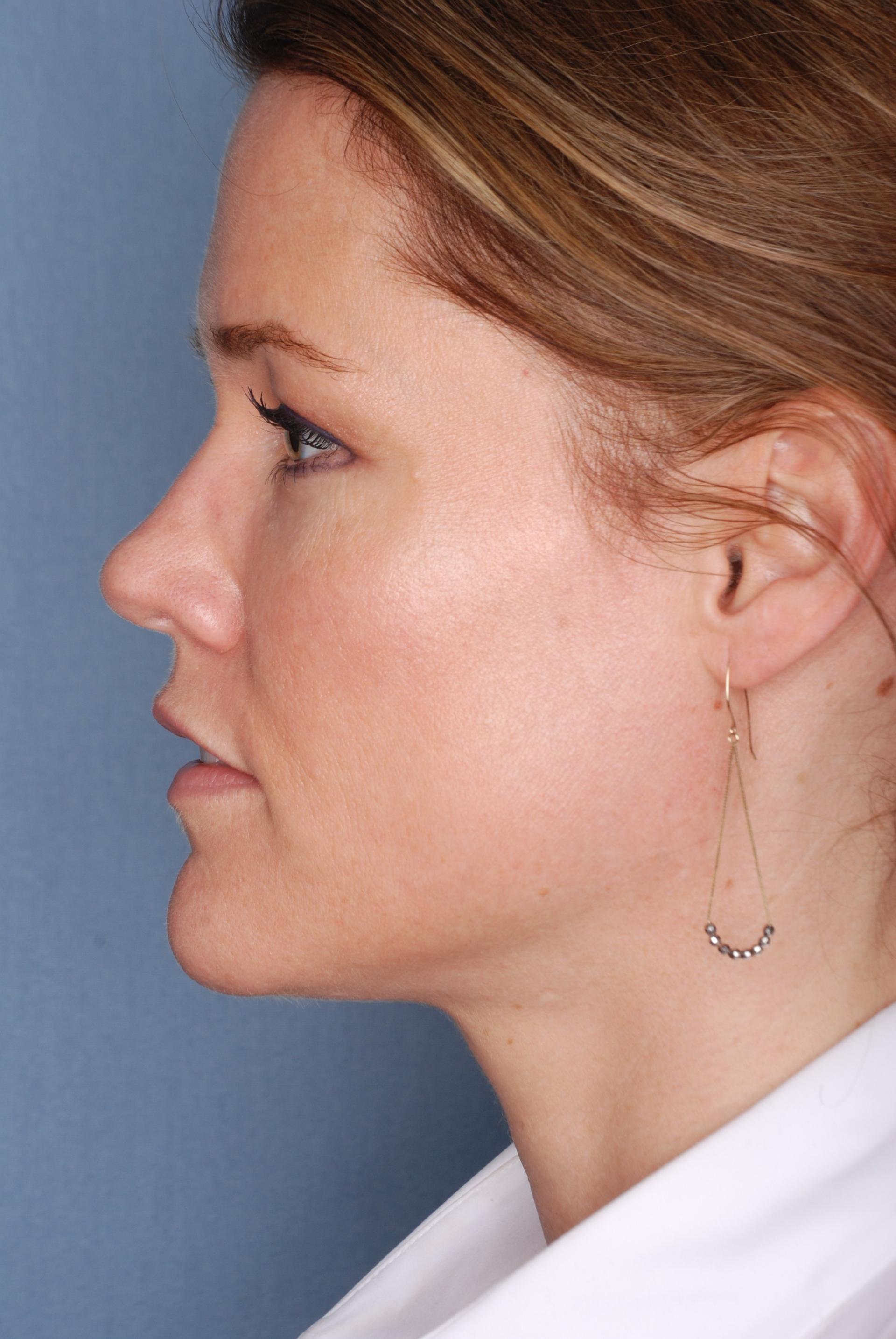 The Few Institute skin tightening after — Chicago, IL