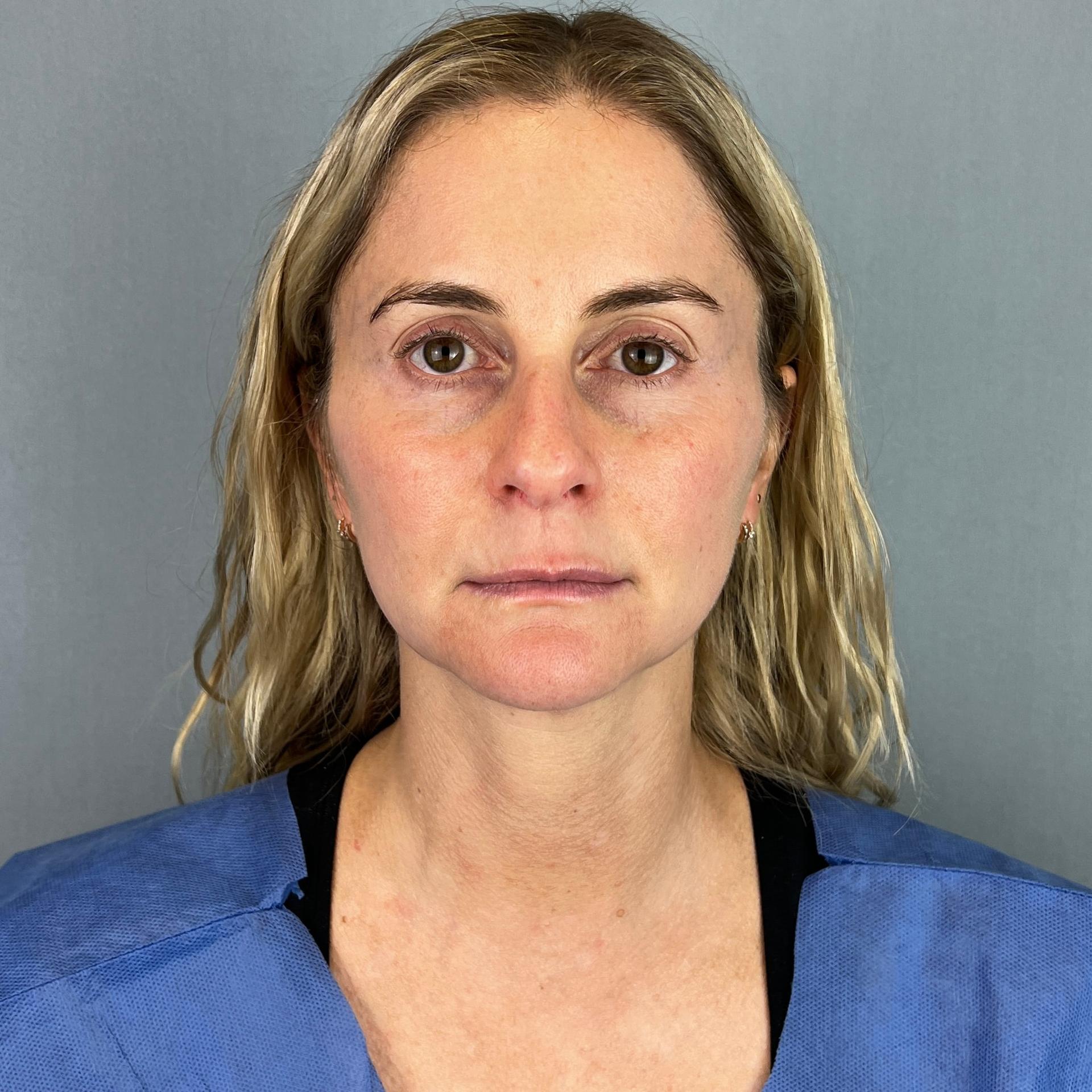 The Few Institute laser treatment after — Chicago, IL