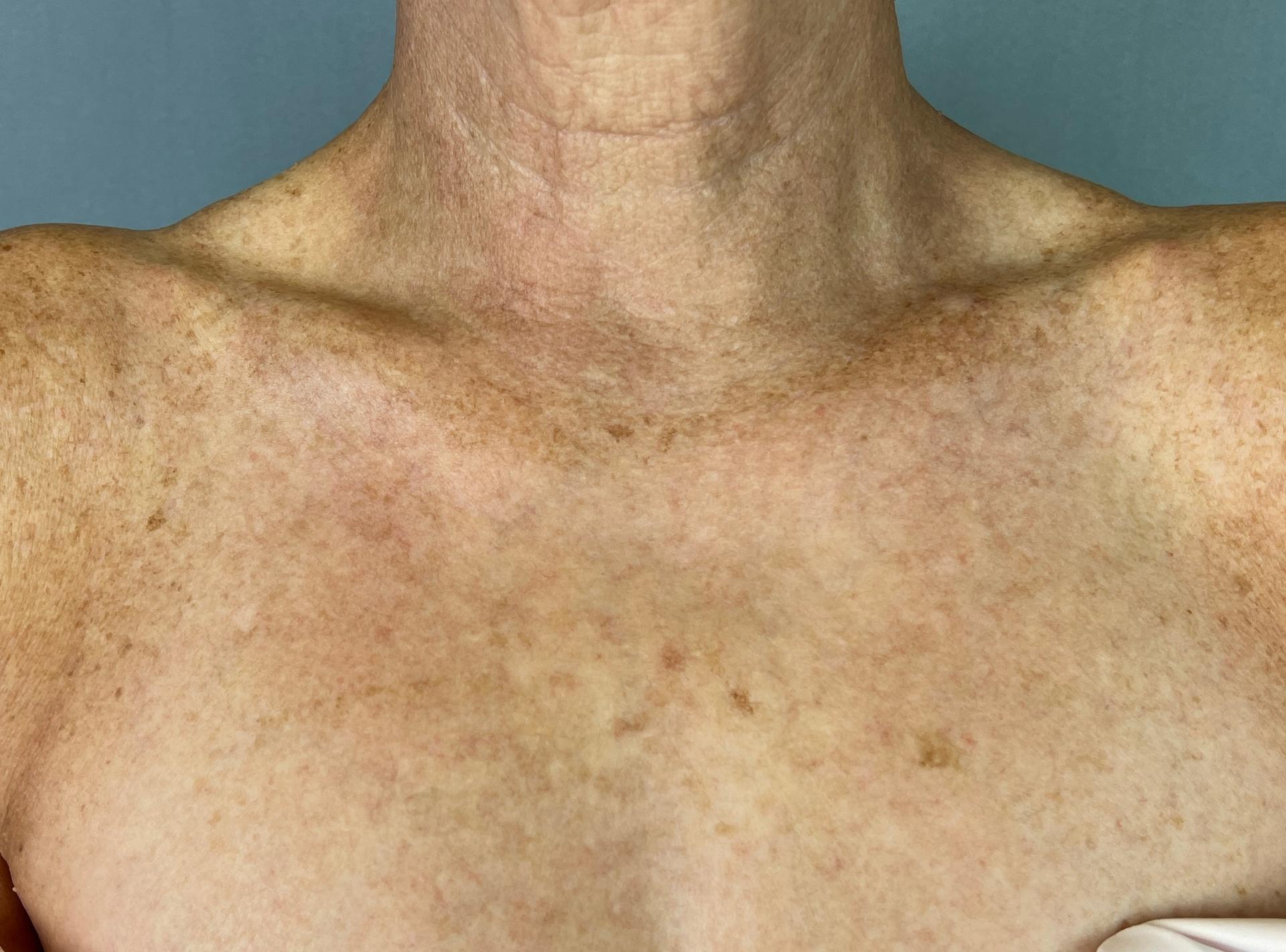 The Few Institute laser treatment after — Chicago, IL