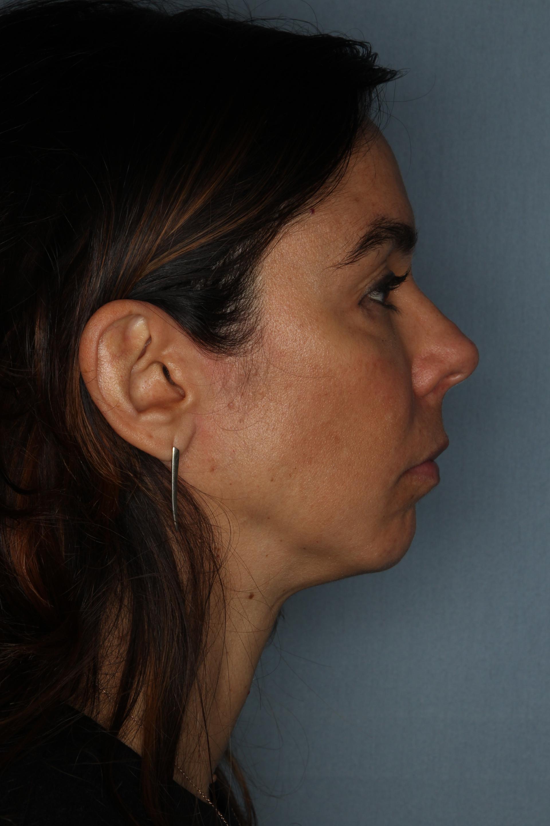 The Few Institute skin tightening after — Chicago, IL