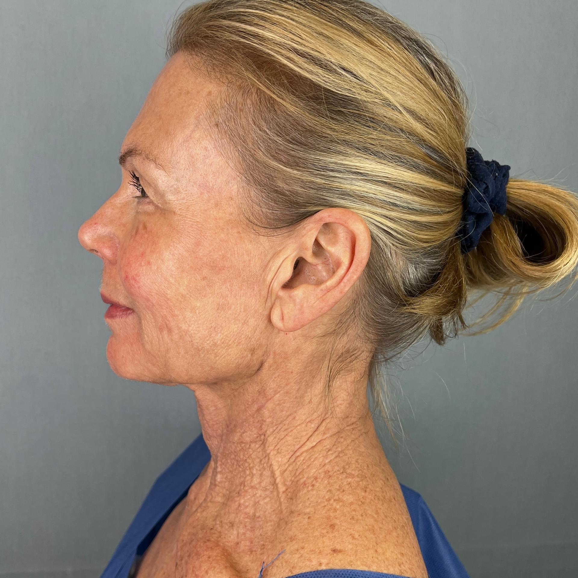 The Few Institute skin tightening after — Chicago, IL