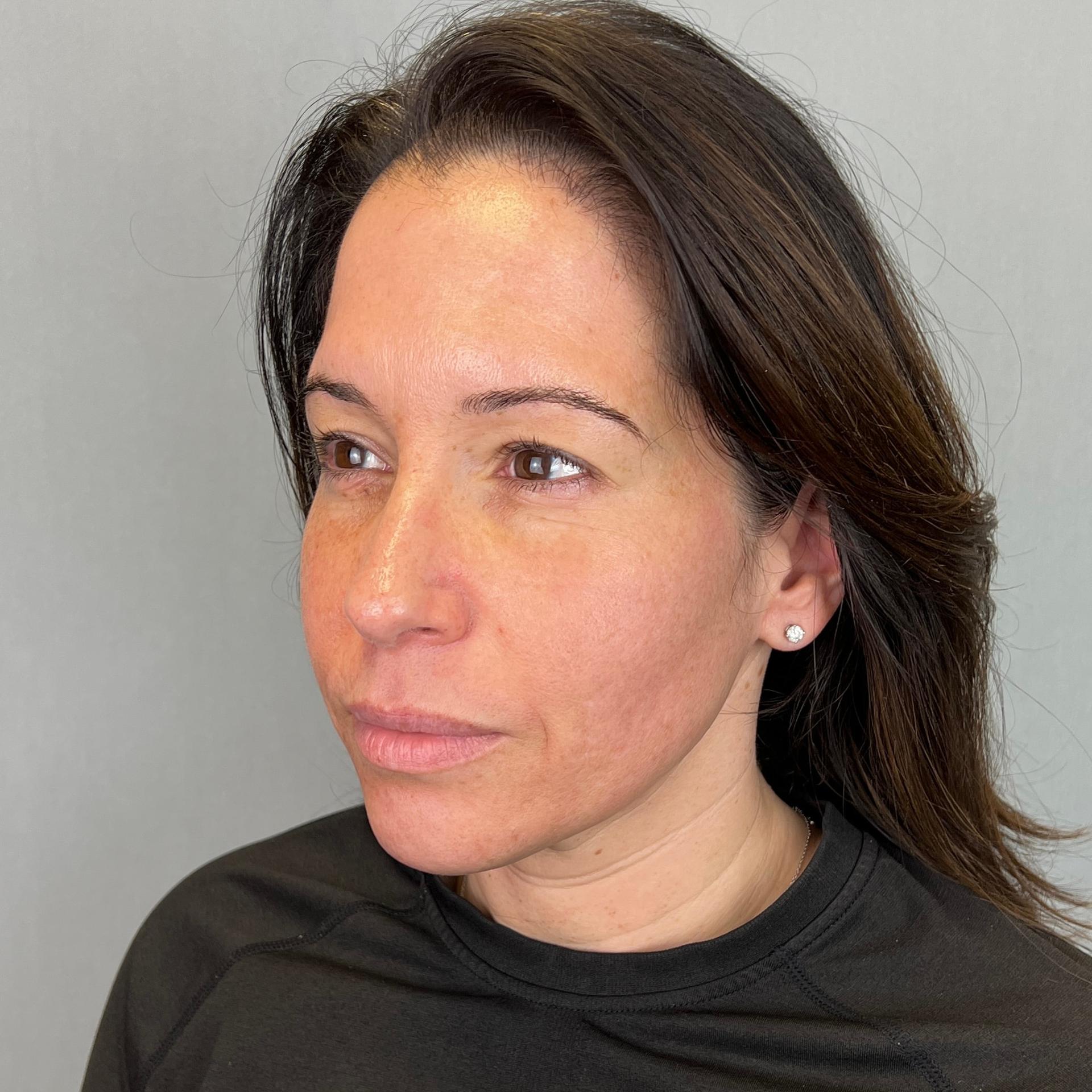 The Few Institute laser treatment after — Chicago, IL