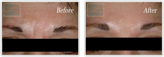 Botox result at Lupo Center for Aesthetic and General Dermatology in New Orleans, LA