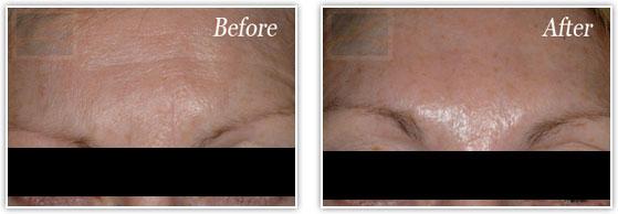 Botox result at Lupo Center for Aesthetic and General Dermatology in New Orleans, LA