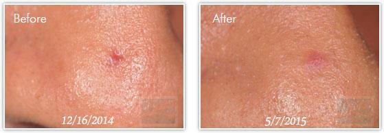 Laser Skin Resurfacing result at Lupo Center for Aesthetic and General Dermatology in New Orleans, LA