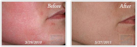 Chemical Peel result at Lupo Center for Aesthetic and General Dermatology in New Orleans, LA