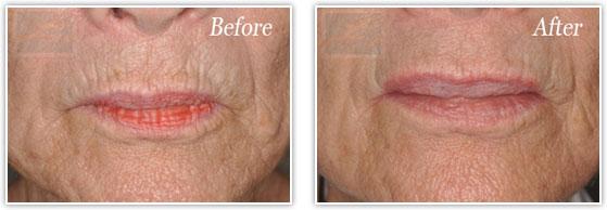 Botox result at Lupo Center for Aesthetic and General Dermatology in New Orleans, LA