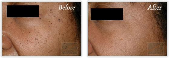 Laser Skin Resurfacing result at Lupo Center for Aesthetic and General Dermatology in New Orleans, LA
