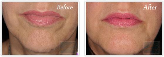 Lupo Center for Aesthetic and General Dermatology lip filler result — New Orleans, LA