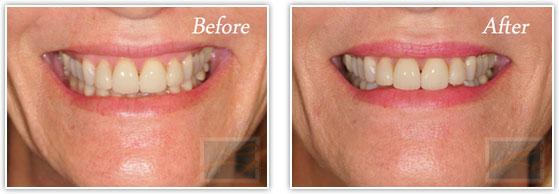 Botox result at Lupo Center for Aesthetic and General Dermatology in New Orleans, LA
