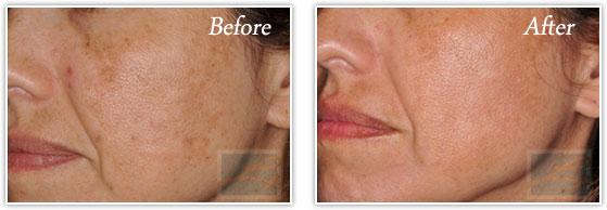 Microneedling result at Lupo Center for Aesthetic and General Dermatology in New Orleans, LA
