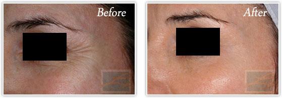 Microneedling result at Lupo Center for Aesthetic and General Dermatology in New Orleans, LA