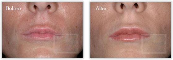 Lip Filler result at Lupo Center for Aesthetic and General Dermatology in New Orleans, LA