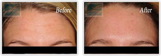 Botox result at Lupo Center for Aesthetic and General Dermatology in New Orleans, LA