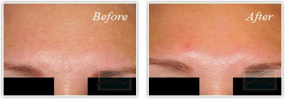 Botox result at Lupo Center for Aesthetic and General Dermatology in New Orleans, LA