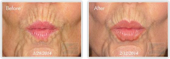 Lip Filler result at Lupo Center for Aesthetic and General Dermatology in New Orleans, LA