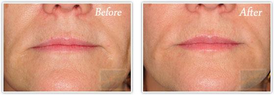 Lupo Center for Aesthetic and General Dermatology lip filler result — New Orleans, LA