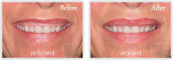 Botox result at Lupo Center for Aesthetic and General Dermatology in New Orleans, LA