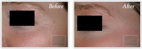 Botox result at Lupo Center for Aesthetic and General Dermatology in New Orleans, LA