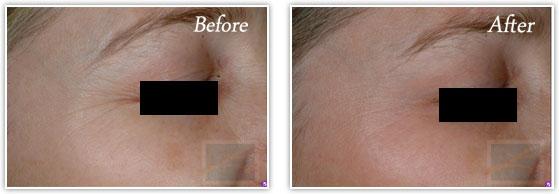 Botox result at Lupo Center for Aesthetic and General Dermatology in New Orleans, LA