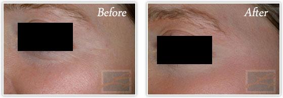 Microneedling result at Lupo Center for Aesthetic and General Dermatology in New Orleans, LA