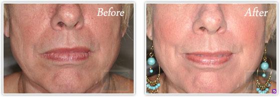 Laser Skin Resurfacing result at Lupo Center for Aesthetic and General Dermatology in New Orleans, LA