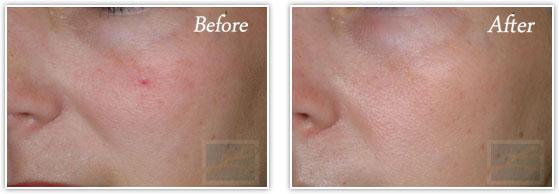 Laser Skin Resurfacing result at Lupo Center for Aesthetic and General Dermatology in New Orleans, LA