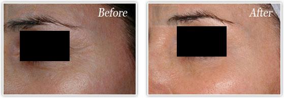 Botox result at Lupo Center for Aesthetic and General Dermatology in New Orleans, LA
