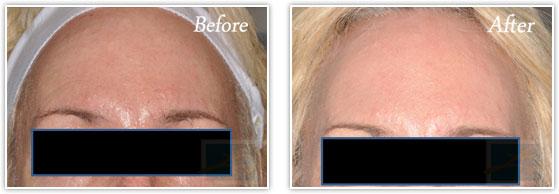 Laser Skin Resurfacing result at Lupo Center for Aesthetic and General Dermatology in New Orleans, LA