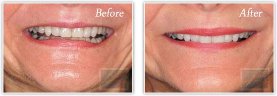 Botox result at Lupo Center for Aesthetic and General Dermatology in New Orleans, LA