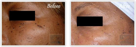 Laser Skin Resurfacing result at Lupo Center for Aesthetic and General Dermatology in New Orleans, LA
